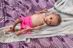 UNICEF peringatkan `bencana` malnutrisi anak akibat harga naik, perang